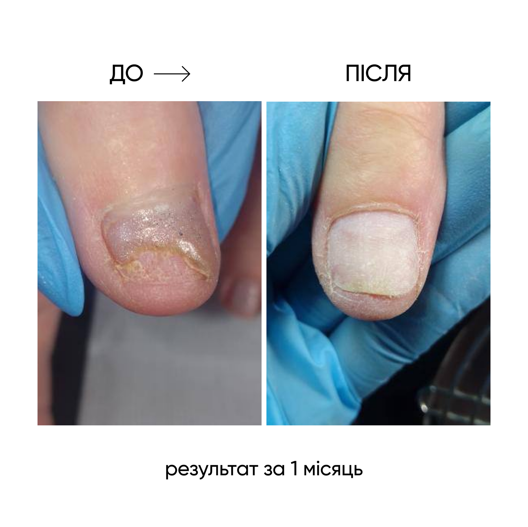 NAILSOFTHEDAY ONISTOP – regenerating oil against onycholysis, 15 ml