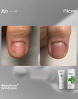 Resultum Onistopix Lotion – Onycholysis Lotion, 10 ml