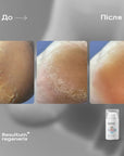 Resultum Regenerix – cream against cracks for hands and feet, 25 ml